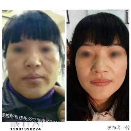 針灸視頻教程銀針秀針灸美雕視頻簡單易學